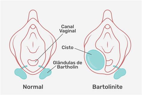 glândulas de bartholin e de skene|Glândula de Bartholin – Wikipédia, a enciclopédia livre